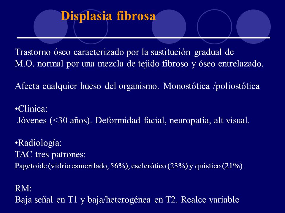 Displasia fibrosa Trastorno óseo caracterizado por la sustitución gradual de M.O. normal por una mezcla de tejido fibroso y óseo entrelazado.