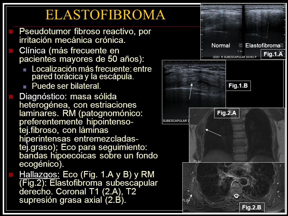 ELASTOFIBROMA Pseudotumor fibroso reactivo, por irritación mecánica crónica. Clínica (más frecuente en pacientes mayores de 50 años):