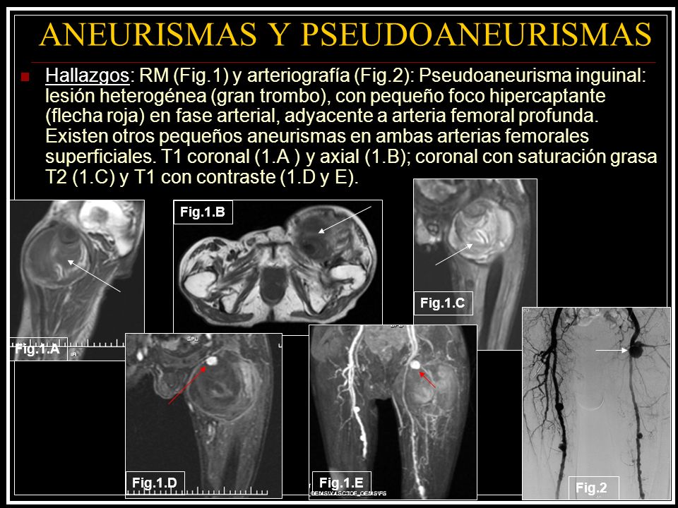 ANEURISMAS Y PSEUDOANEURISMAS