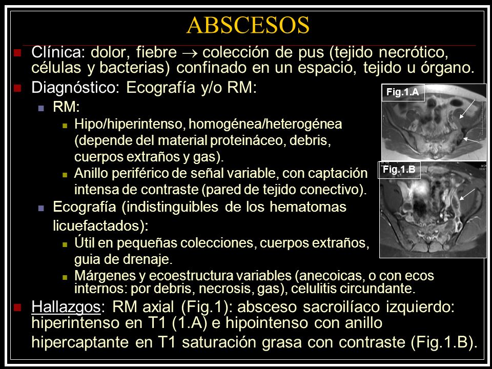 ABSCESOS Clínica: dolor, fiebre  colección de pus (tejido necrótico, células y bacterias) confinado en un espacio, tejido u órgano.