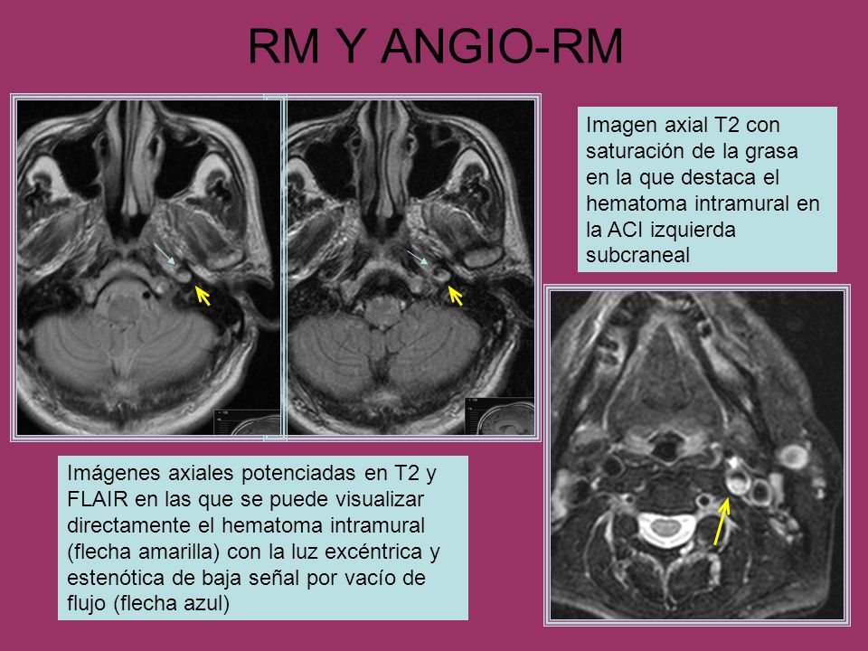 RM Y ANGIO-RM Imagen axial T2 con saturación de la grasa en la que destaca el hematoma intramural en la ACI izquierda subcraneal.
