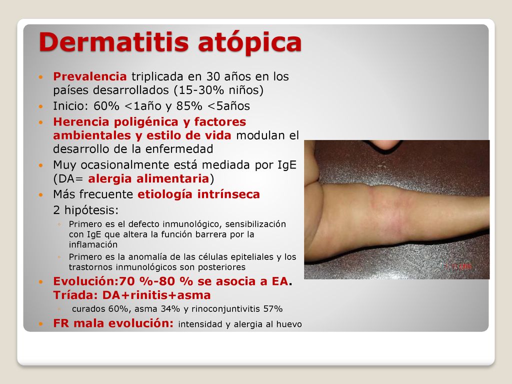 Dermatitis atópica Prevalencia triplicada en 30 años en los países desarrollados (15-30% niños) Inicio: 60% <1año y 85% <5años.