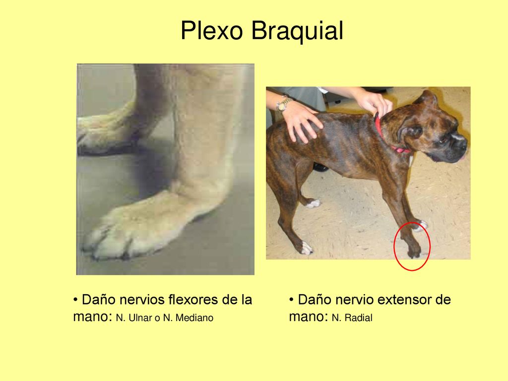 Plexo Braquial Daño nervios flexores de la mano: N. Ulnar o N. Mediano