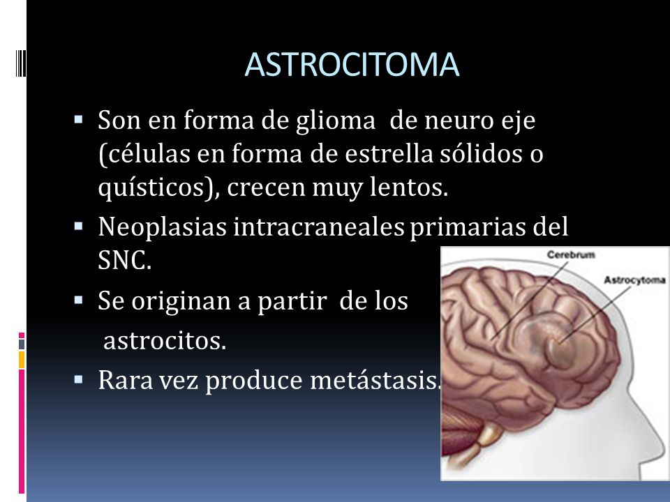 ASTROCITOMA Son en forma de glioma de neuro eje (células en forma de estrella sólidos o quísticos), crecen muy lentos.