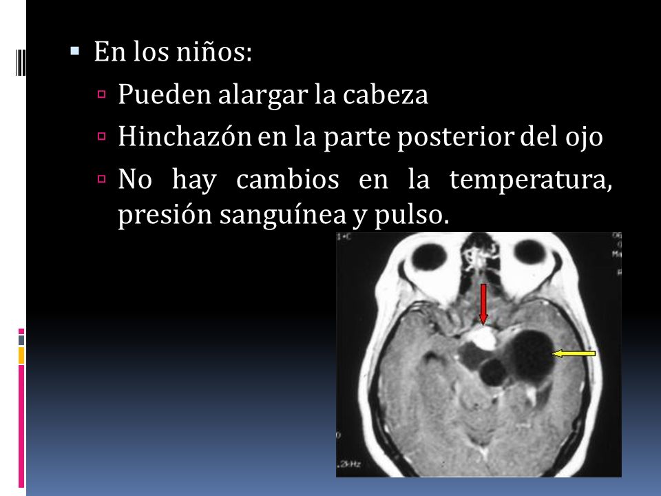 En los niños: Pueden alargar la cabeza. Hinchazón en la parte posterior del ojo.