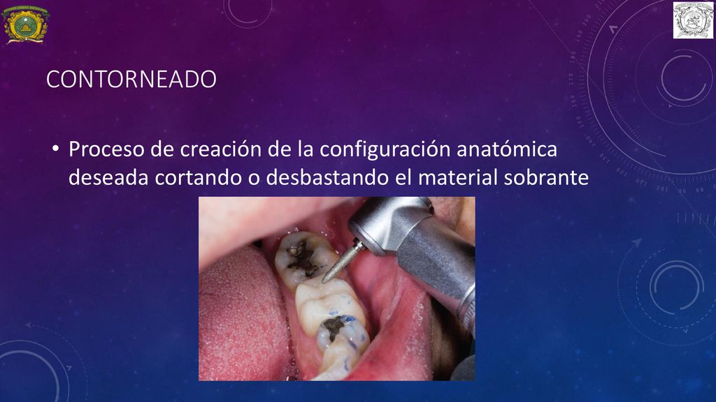 contorneado Proceso de creación de la configuración anatómica deseada cortando o desbastando el material sobrante.