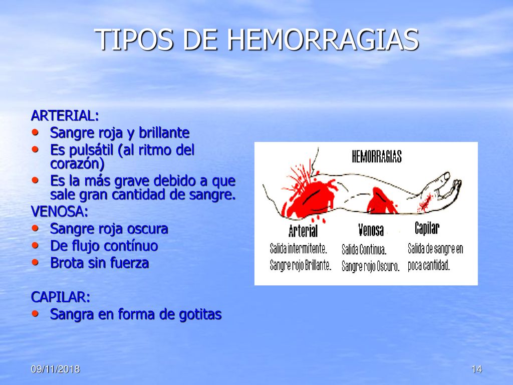 TIPOS DE HEMORRAGIAS ARTERIAL: Sangre roja y brillante