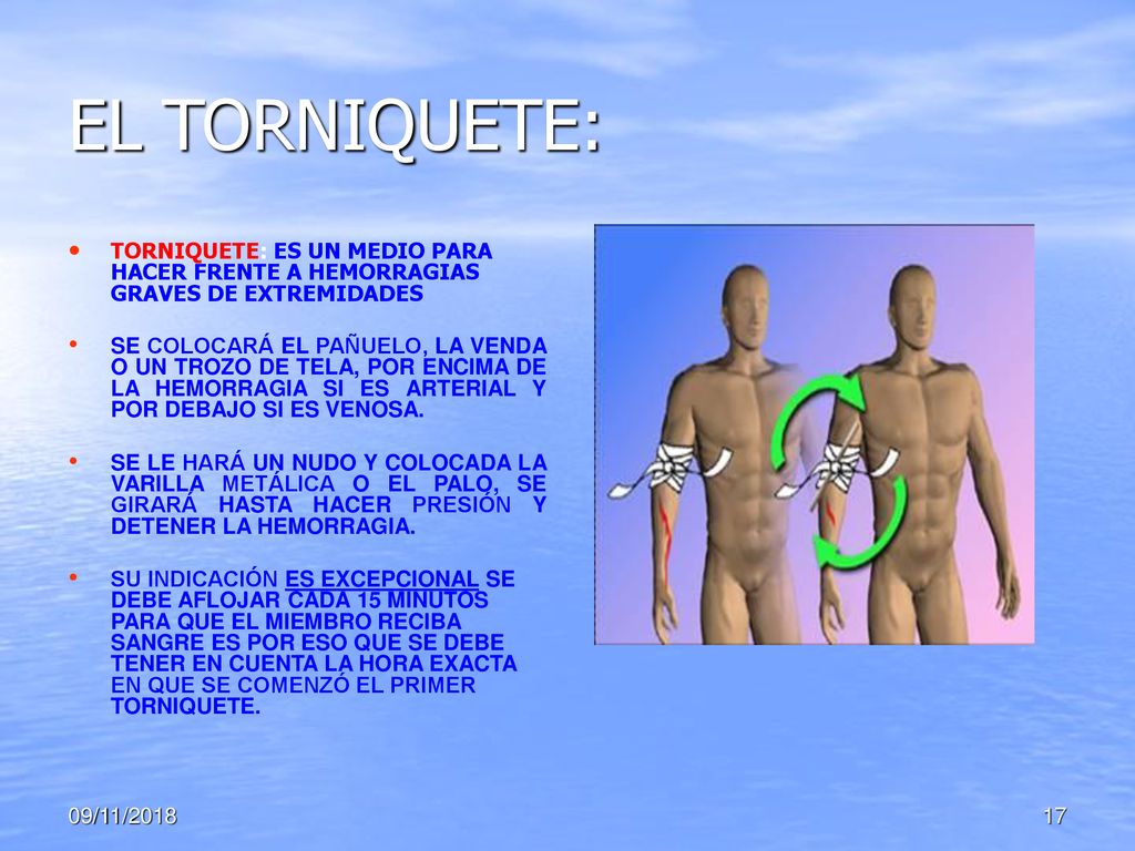 EL TORNIQUETE: TORNIQUETE: ES UN MEDIO PARA HACER FRENTE A HEMORRAGIAS GRAVES DE EXTREMIDADES.