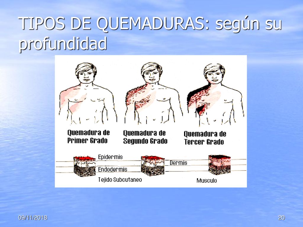 TIPOS DE QUEMADURAS: según su profundidad