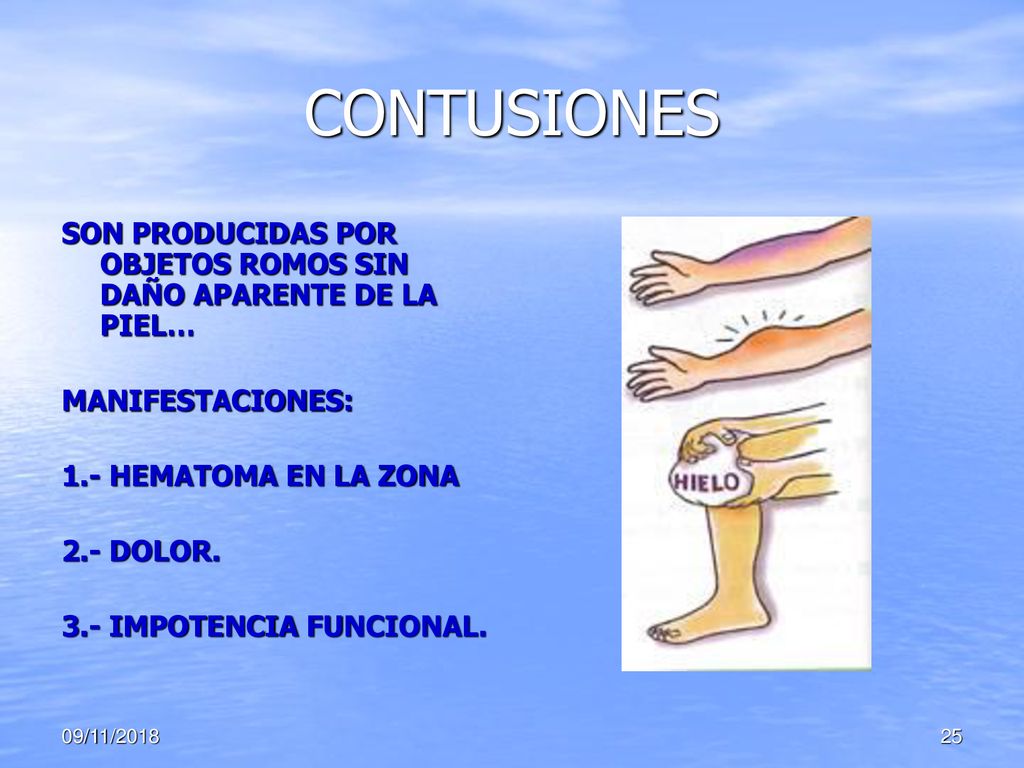 CONTUSIONES SON PRODUCIDAS POR OBJETOS ROMOS SIN DAÑO APARENTE DE LA PIEL… MANIFESTACIONES: 1.- HEMATOMA EN LA ZONA.