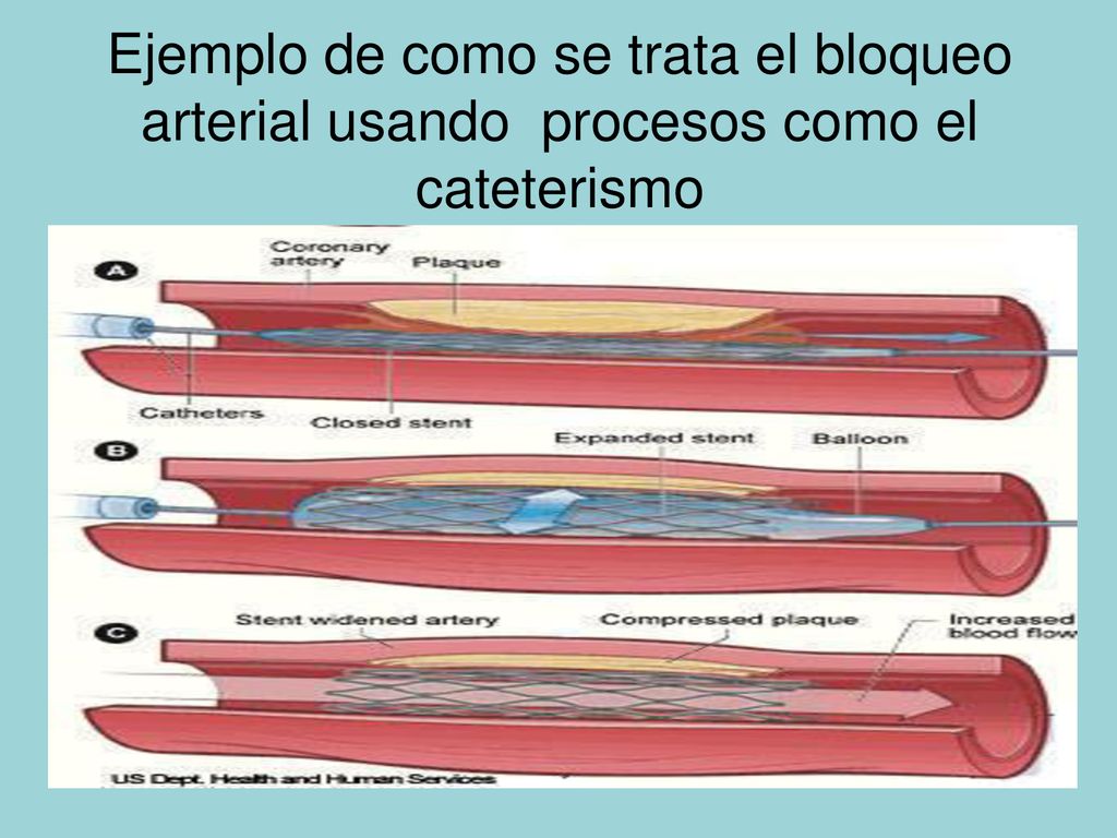 Ejemplo de como se trata el bloqueo arterial usando procesos como el cateterismo