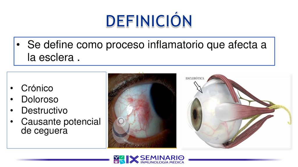 DEFINICIÓN Se define como proceso inflamatorio que afecta a la esclera . Crónico. Doloroso. Destructivo.