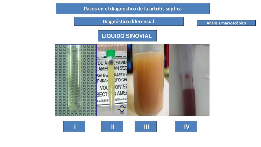 I II III IV Pasos en el diagnóstico de la artritis séptica