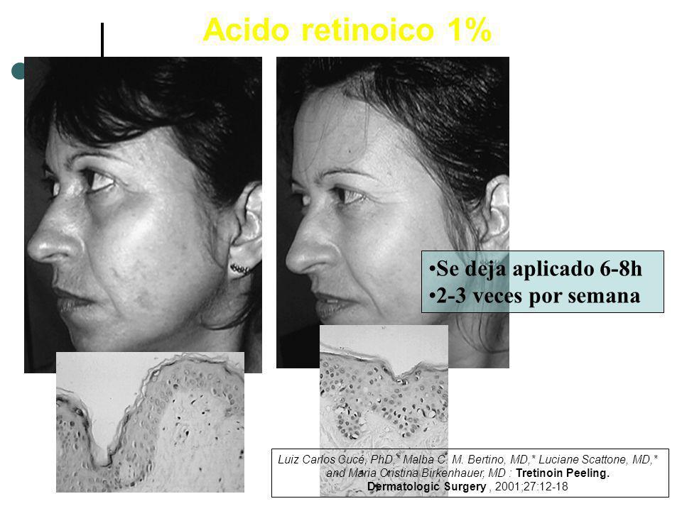 Acido retinoico 1% Se deja aplicado 6-8h 2-3 veces por semana