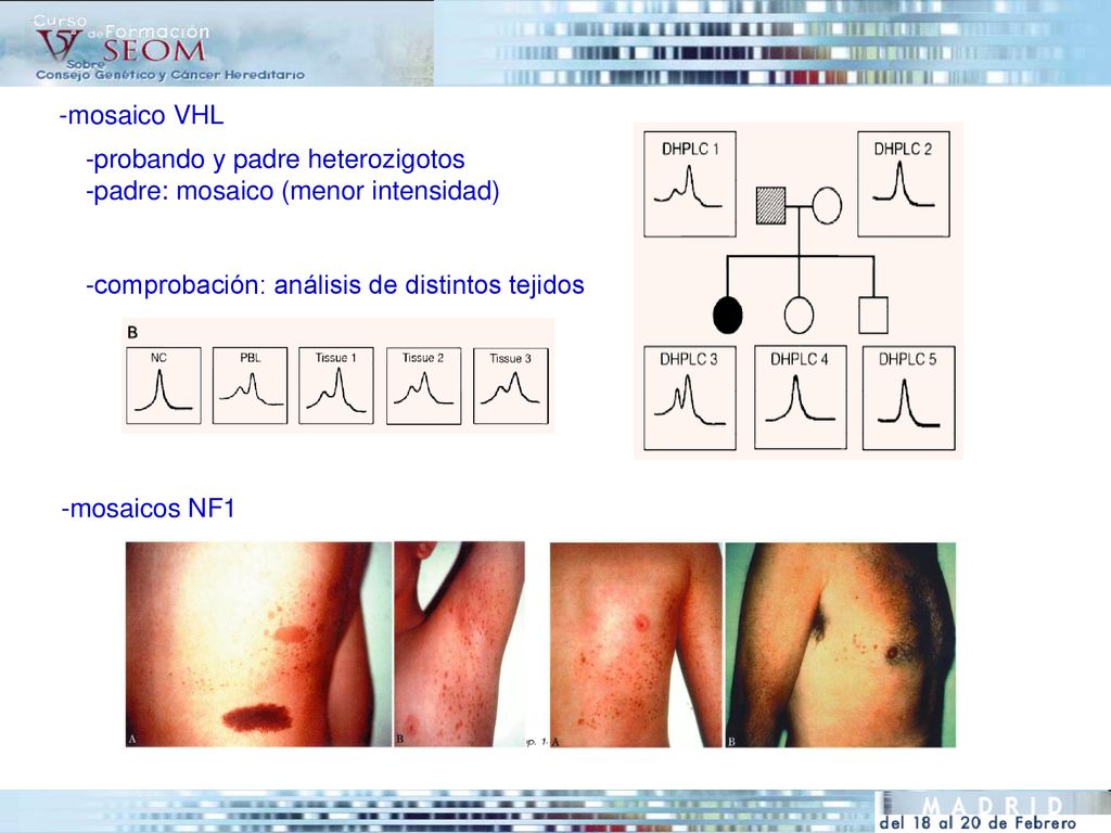 -mosaico VHL -probando y padre heterozigotos. -padre: mosaico (menor intensidad) -comprobación: análisis de distintos tejidos.