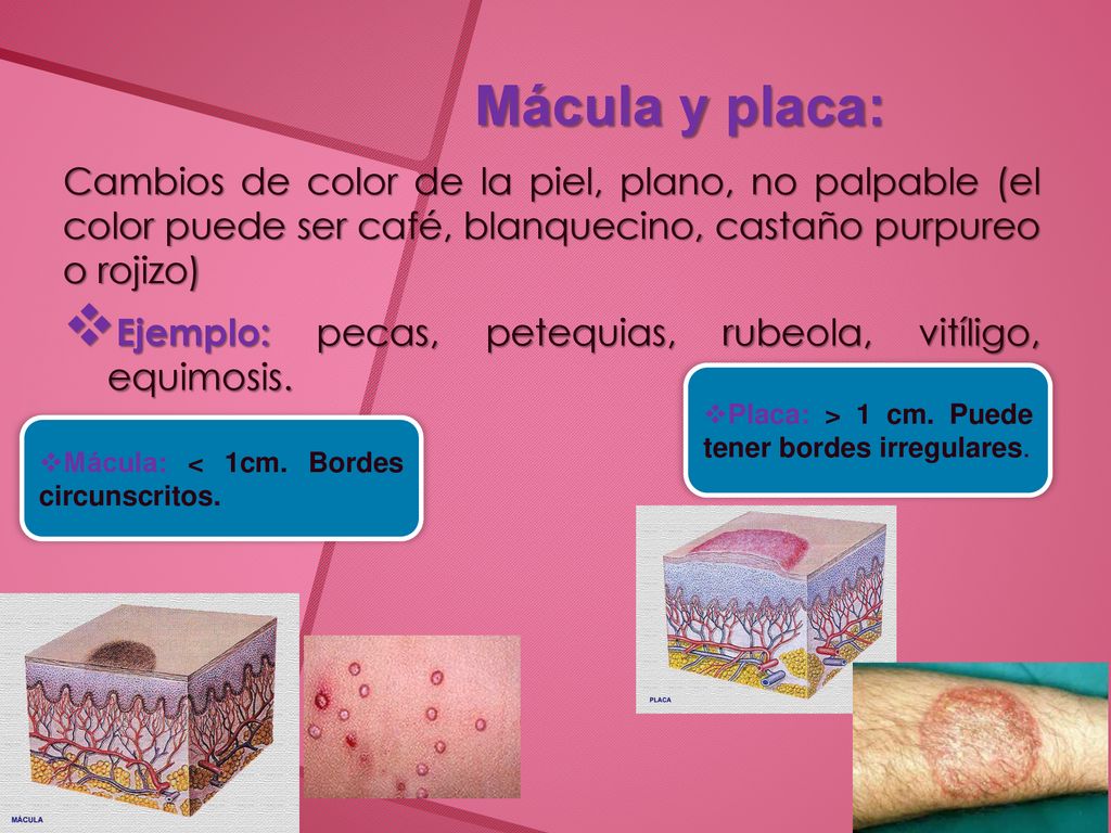 Mácula y placa: Cambios de color de la piel, plano, no palpable (el color puede ser café, blanquecino, castaño purpureo o rojizo)