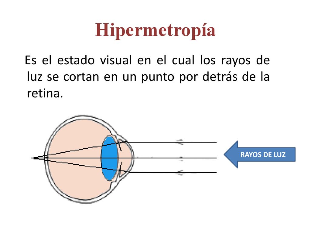 Hipermetropía Es el estado visual en el cual los rayos de luz se cortan en un punto por detrás de la retina.