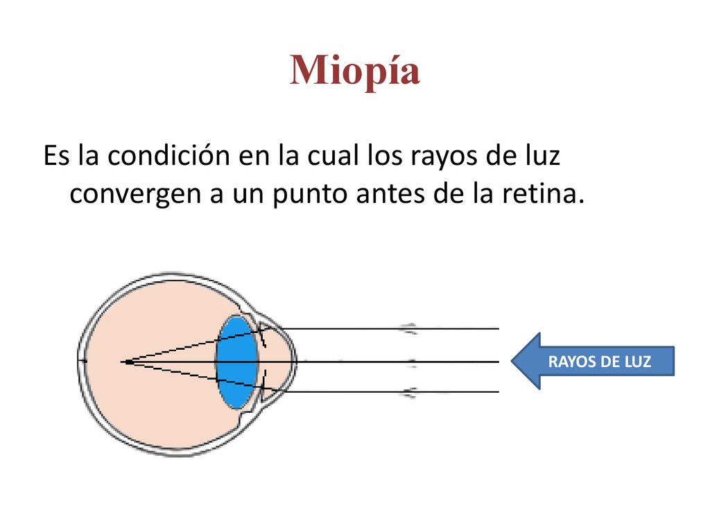 Miopía Es la condición en la cual los rayos de luz convergen a un punto antes de la retina.