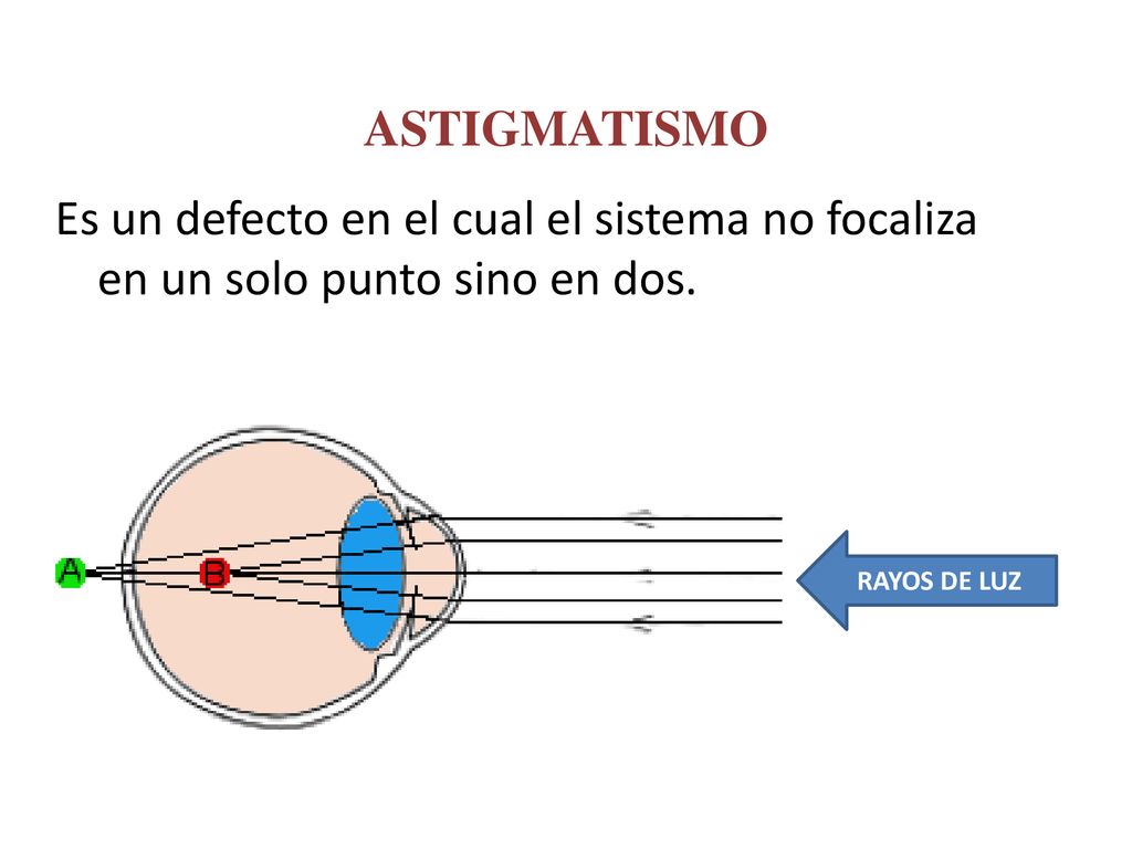 ASTIGMATISMO Es un defecto en el cual el sistema no focaliza en un solo punto sino en dos.