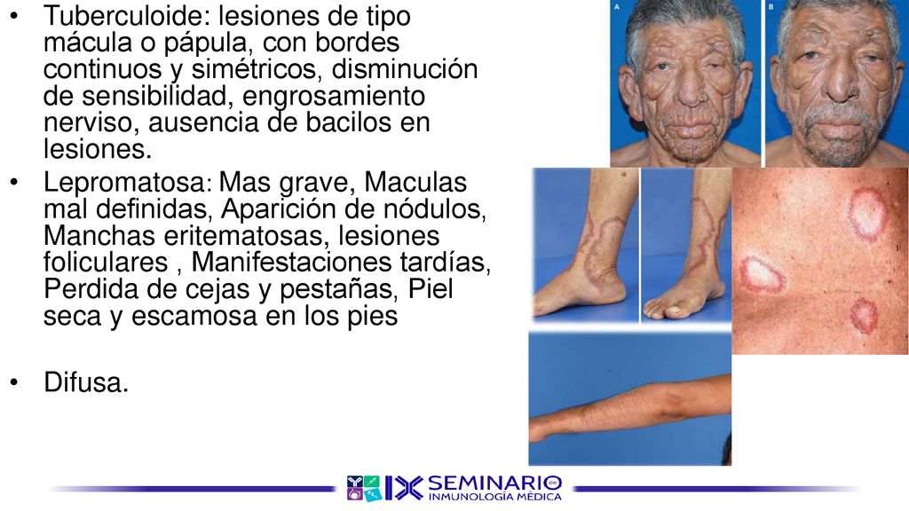Tuberculoide: lesiones de tipo mácula o pápula, con bordes continuos y simétricos, disminución de sensibilidad, engrosamiento nerviso, ausencia de bacilos en lesiones.