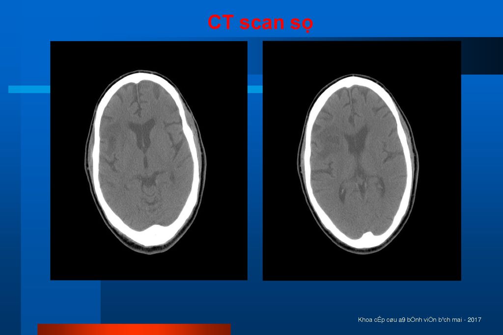 CT scan sọ Khoa cÊp cøu a9 bÖnh viÖn b¹ch mai