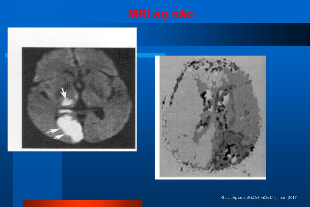 MRI sọ não Khoa cÊp cøu a9 bÖnh viÖn b¹ch mai
