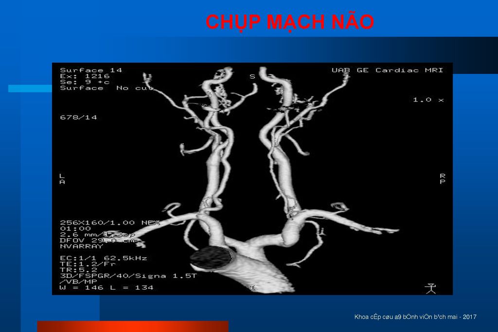 CHỤP MẠCH NÃO Khoa cÊp cøu a9 bÖnh viÖn b¹ch mai