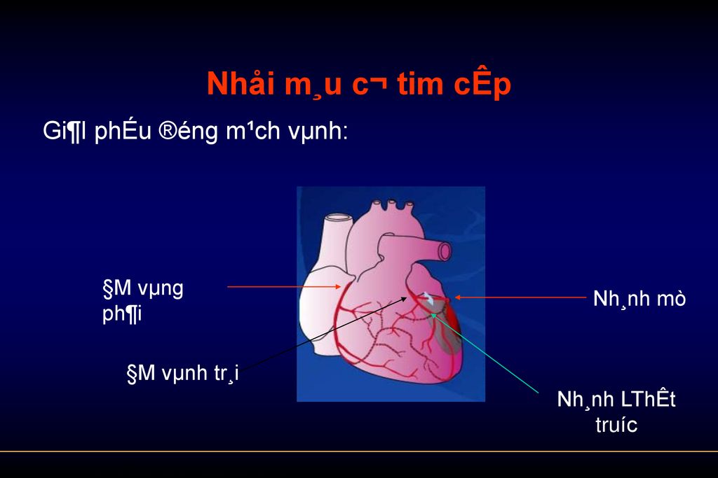 Nhåi m¸u c¬ tim cÊp Gi¶I phÉu ®éng m¹ch vµnh: §M vµng ph¶i Nh¸nh mò