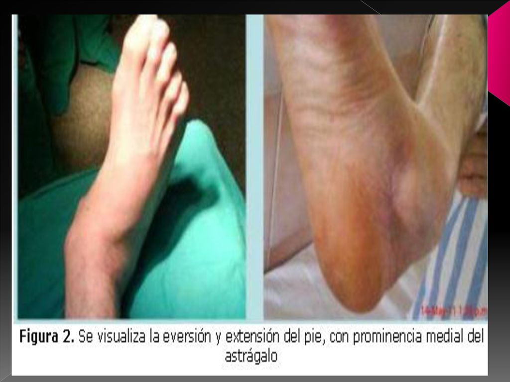Clasificación. Completas: Pérdida total del cartílago articular , las superficies articulares de la articulación están totalmente separadas.