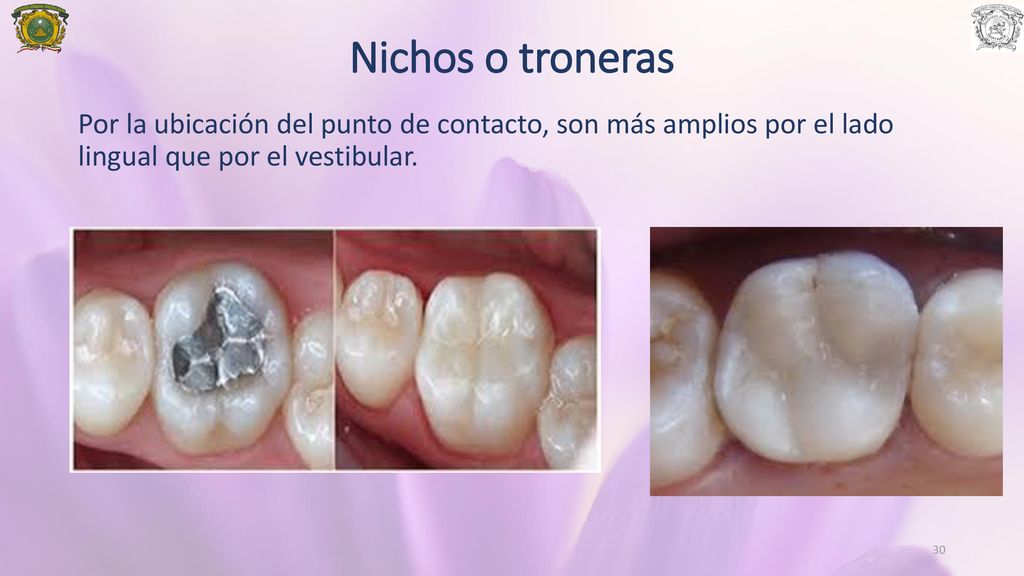 Nichos o troneras Por la ubicación del punto de contacto, son más amplios por el lado lingual que por el vestibular.