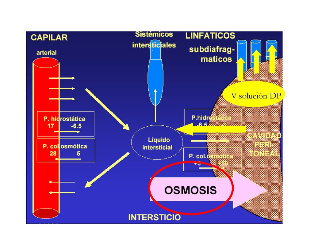 V solución DP En el capilar la presion hidrostática es favorable con pequeña filtración al intersticio y peritoneal por presion coloidosmótica.
