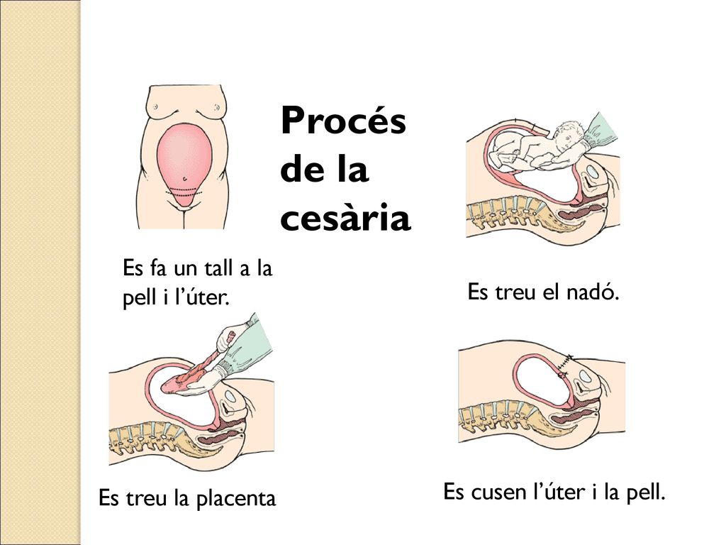 Procés de la cesària Es fa un tall a la pell i l’úter.