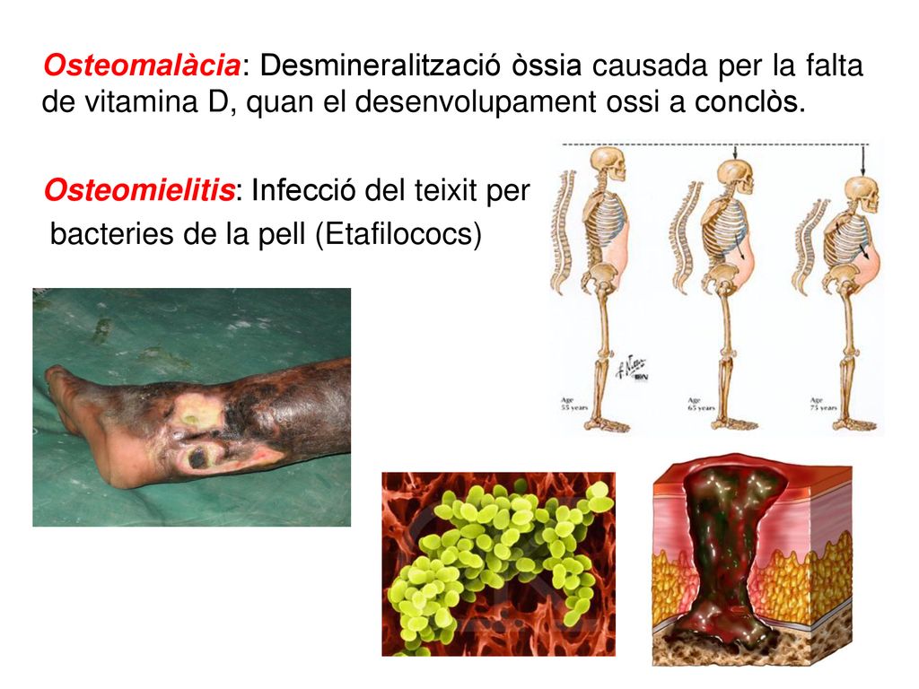Osteomalàcia: Desmineralització òssia causada per la falta de vitamina D, quan el desenvolupament ossi a conclòs.