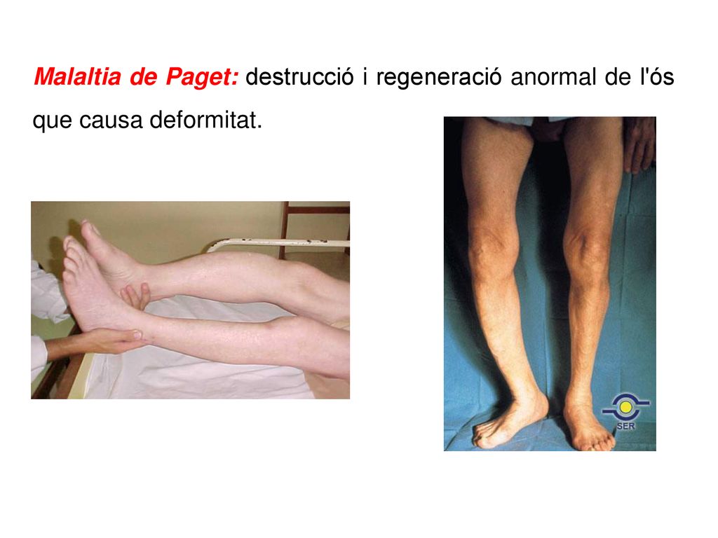 Malaltia de Paget: destrucció i regeneració anormal de l ós que causa deformitat.