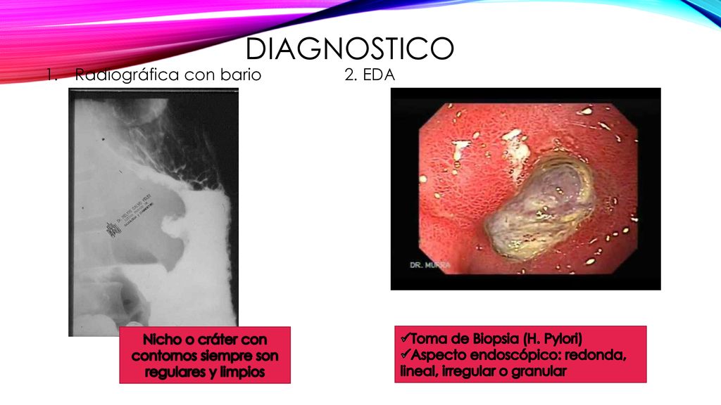 Nicho o cráter con contornos siempre son regulares y limpios