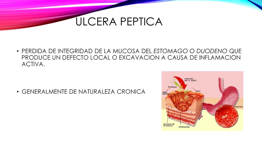 ULCERA PEPTICA PERDIDA DE INTEGRIDAD DE LA MUCOSA DEL ESTOMAGO O DUODENO QUE PRODUCE UN DEFECTO LOCAL O EXCAVACION A CAUSA DE INFLAMACION ACTIVA.