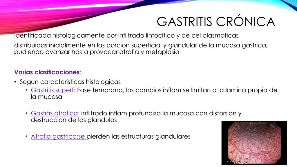 Gastritis crónica Identificada histologicamente por infiltrado linfocitico y de cel plasmaticas.