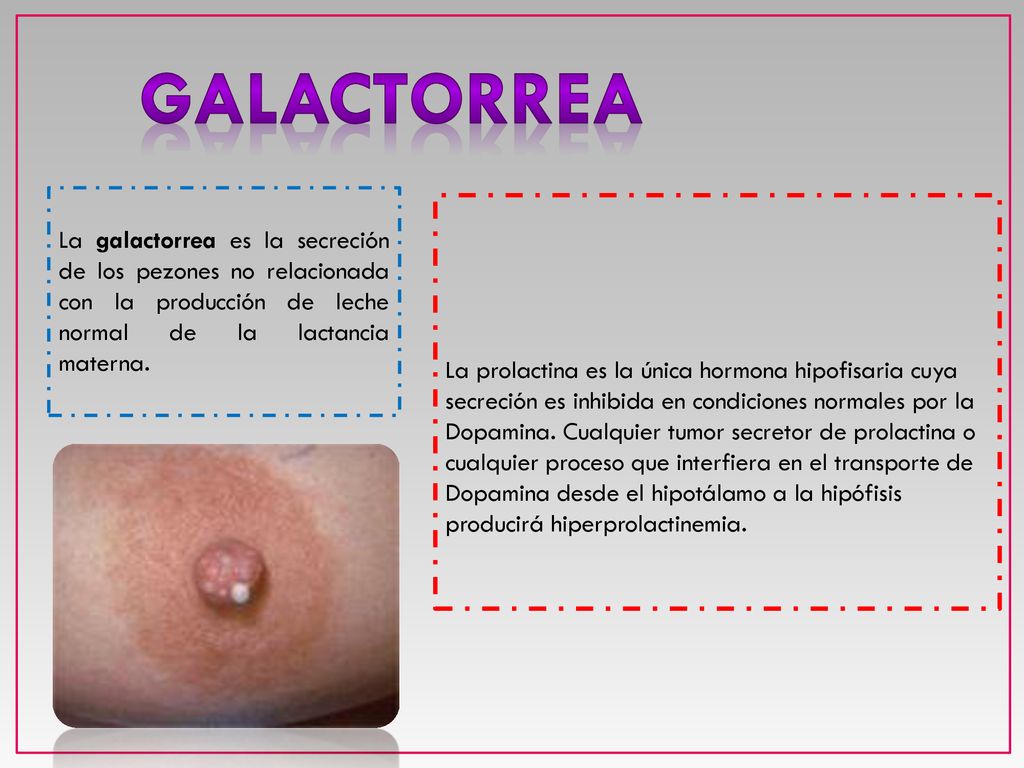 GALACTORREA La galactorrea es la secreción de los pezones no relacionada con la producción de leche normal de la lactancia materna.