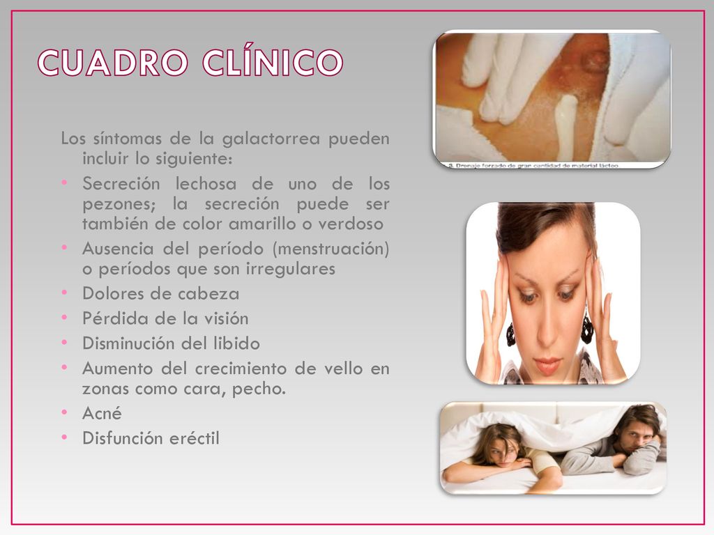 CUADRO CLÍNICO Los síntomas de la galactorrea pueden incluir lo siguiente: