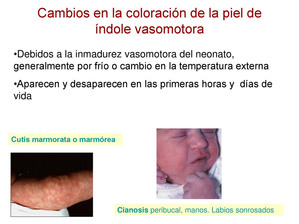 Cambios en la coloración de la piel de índole vasomotora