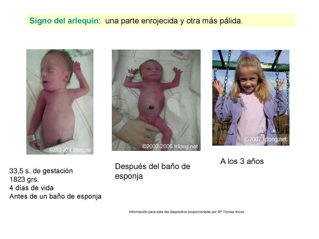 Signo del arlequín: una parte enrojecida y otra más pálida.