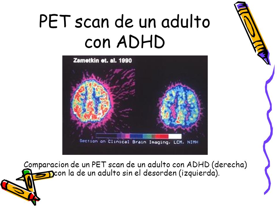 PET scan de un adulto con ADHD