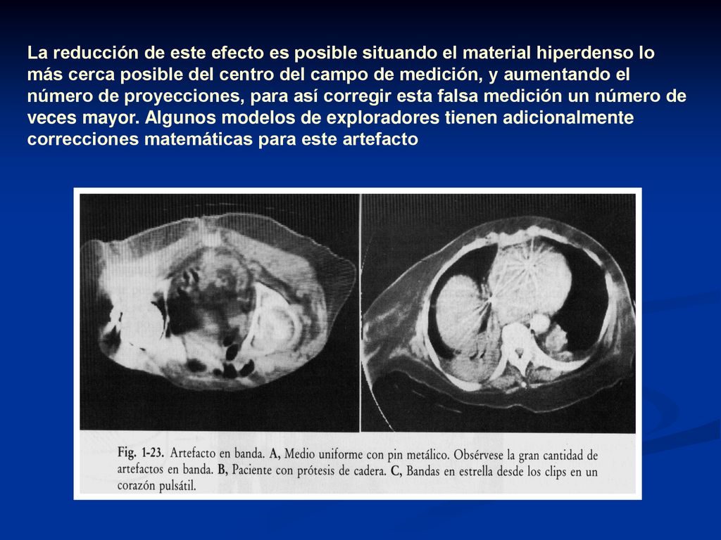 La reducción de este efecto es posible situando el material hiperdenso lo más cerca posible del centro del campo de medición, y aumentando el número de proyecciones, para así corregir esta falsa medición un número de veces mayor.