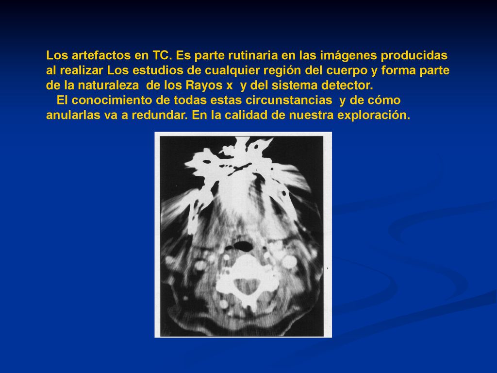 Los artefactos en TC. Es parte rutinaria en las imágenes producidas al realizar Los estudios de cualquier región del cuerpo y forma parte de la naturaleza de los Rayos x y del sistema detector.