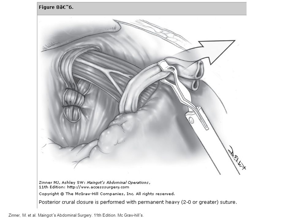 Zinner, M. et al. Maingot´s Abdominal Surgery. 11th Edition