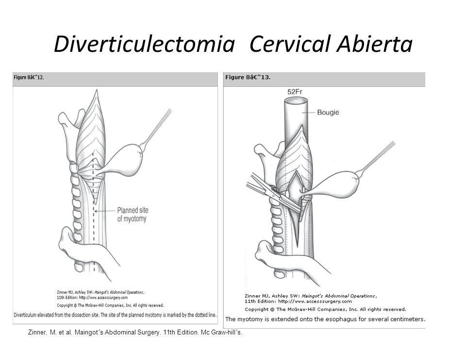 Diverticulectomia Cervical Abierta