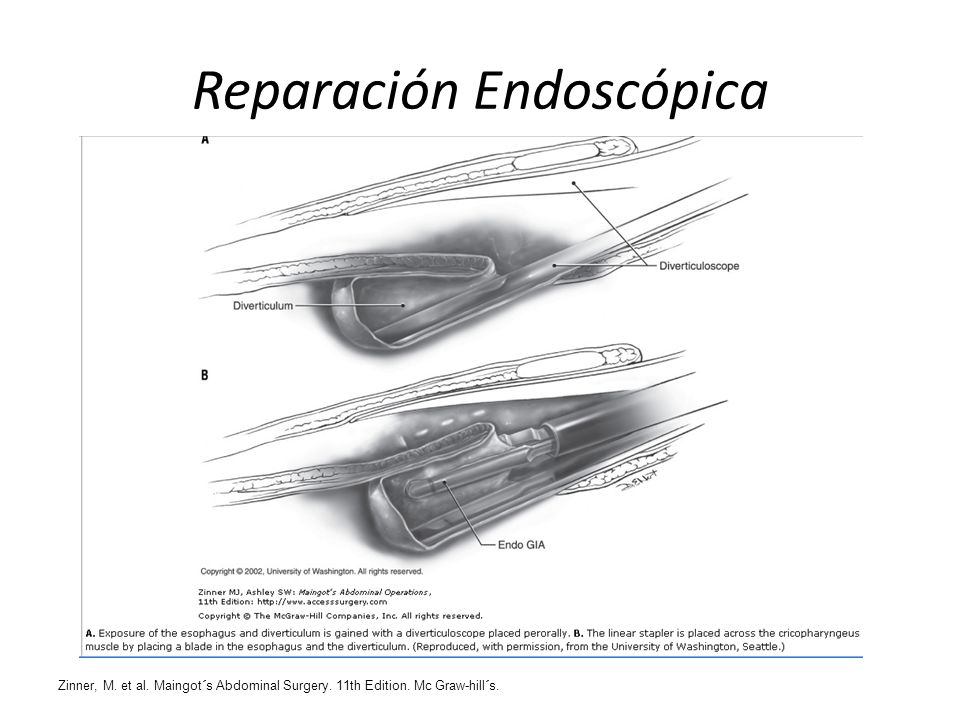 Reparación Endoscópica