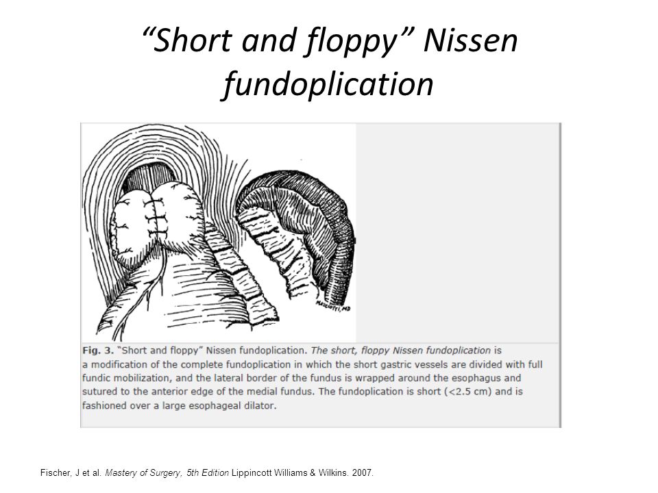 Short and floppy Nissen fundoplication