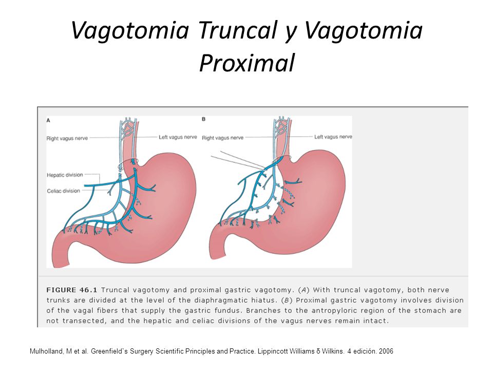 Vagotomia Truncal y Vagotomia Proximal