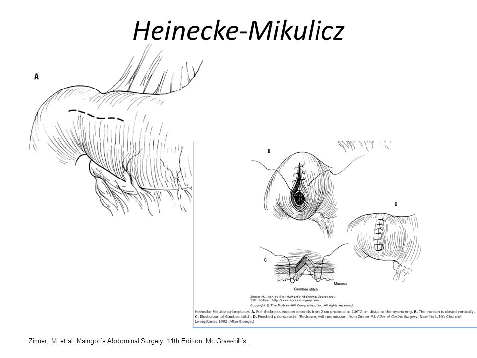 Heinecke-Mikulicz Zinner, M. et al. Maingot´s Abdominal Surgery. 11th Edition. Mc Graw-hill´s.